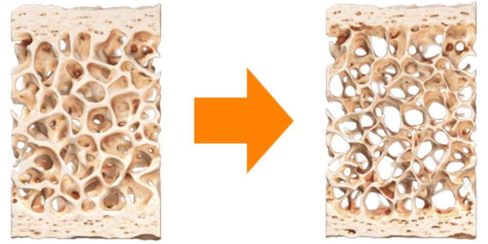 Osteoporosis and Vertigo – What's the Connection?